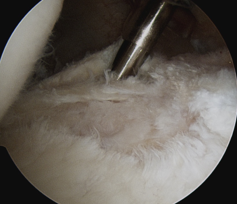 Posterior Labral Tear Cyst 3